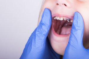 Was können faule Zähne verursachen?